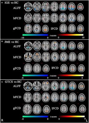 Disrupted Coupling Between the Spontaneous Fluctuation and Functional Connectivity in Idiopathic Generalized Epilepsy